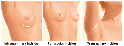Breast Augmentation Incision Placements 