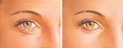 lower eyelid surgery incision drawiang