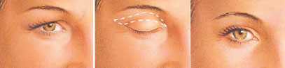 upper eyelid surgery incision drawing