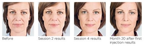 Sculptra Aesthetic before and 20 months after
